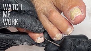 Gentle salon pedicure for mature feet Involuted nails cut too short Watch Me Work [upl. by Abih]