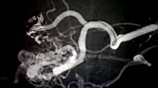 AVM embolization Vanderbilt Neurovascular Surgery [upl. by Ahsetel887]