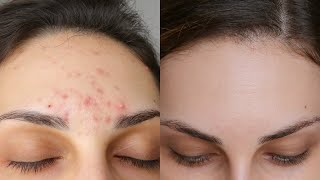 Doctor explains how to use BENZOYL PEROXIDE for ACNE aka PanOxyl  Acnecide  Side effects amp more [upl. by Fortunato943]