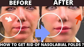 HOW TO GET RID OF NASOLABIAL FOLDS NATURALLY  LAUGH LINES  SAGGING SKIN JOWLS FOREHEAD LINES [upl. by Torras]