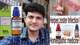 Herpes Zoster  Homeopathic Medicine for Herpes Zoster  Explain [upl. by Niarbo117]