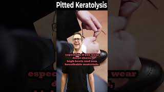 Easy way to cure pitted keratolysis cara menyembukan kaki rayapan [upl. by Inuat]