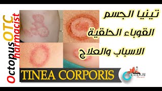 Tinea corporis Ringworm  تينيا الجسم  القوباء الحلقية  الأعراض والعلاج والوقاية [upl. by Ecinaj]