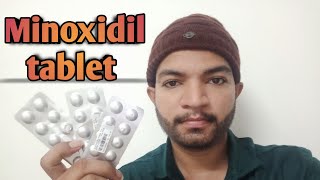 Oral minoxidil journey tamil [upl. by Marguerita42]