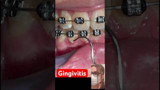 Gingivitis Braces Orthodontics treatments [upl. by Makell908]