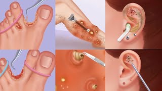 ASMR  Cleaning Ear 👂 Removing maggots amp Hair  Peeling off Infected Skin  Animation ASMR [upl. by Eeraj]