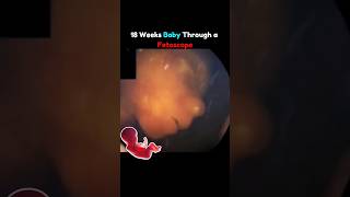 18 Weeks Baby Through Fetoscope 🤩💕 pregnancy fetus [upl. by Mihe968]