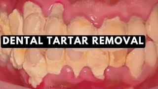 How Dental Tartar  Calculus is removed at the Dentist [upl. by Atiuqes]