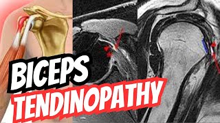 Biceps Tendinopathy Presentation  Orthopaedics High Yield Topics 10 [upl. by Hulbig]