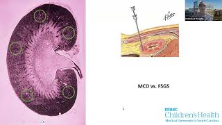 Pediatric FSGS and the Utility of Lipopheresis CME Recording [upl. by Noble]