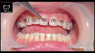 DIASTEMA CLOSURE  BRACES  Orthodontics dentalbraces dentalclinic dental trending anantnag 🙂🙂🙂 [upl. by Dearborn268]