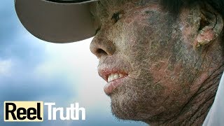 My Skin is Killing Me  Epidermolysis Bullosa  Extraordinary People Documentary  Reel Truth [upl. by Sirahs]