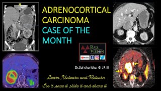 Adrenocortical carcinoma CASE OF THE MONTH [upl. by Innus]