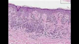 Histopathology SkinCompound Clarks nevus dysplastic nevus [upl. by Weiman10]