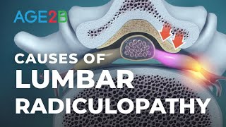 What Causes Lumbar Radiculopathy  Lumbar Nerve Roots  Disc Bulge [upl. by Gottuard900]