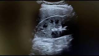 Ultrasound of acute pyelonephritis Read in description section n commrnt for detail history [upl. by Sneed]