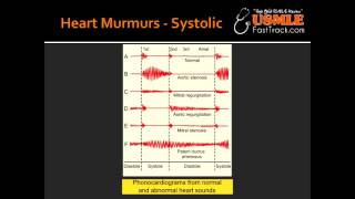 Heart Murmurs  Aortic Stenosis [upl. by Missie]