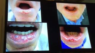 Queilitis actinica Como lo maneja usted Bucaramanga 2016 [upl. by Iniffit113]