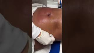 Coolsculpting  Clínica Luciana Hitomi procedimentosesteticos [upl. by Chance]