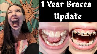 1 YEAR ADULT BRACES UPDATE🦷Progress Elastics Current Routine  More [upl. by Adnilemre]