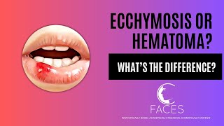 Whats the difference between a Bruise ecchymosis and a hematoma [upl. by Ahsikrats]