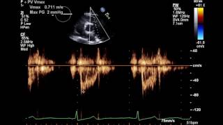 Normal Complete 2D Echocardiogram with Color Doppler and Spectral Doppler [upl. by Illib499]