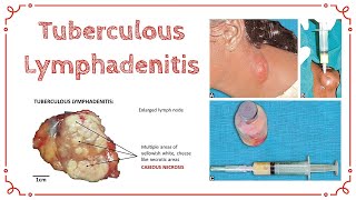 TUBERCULOUS LYMPHADENITIS  Stages Of TB Lymphadenitis  Cold Abscess  General Surgery [upl. by Eph]