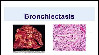 Bronchiectasis [upl. by Fishman]