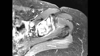 Chondrosarcoma of the Acetabulum [upl. by Peterman]