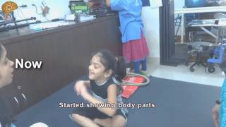 Dystonic Cerebral Palsy New Treatment Results  Quick Look [upl. by Anialahs]