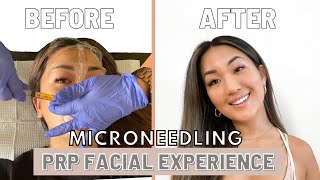 PRP Injections to Face and Neck Blood Facial [upl. by Bolitho]