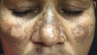 Treatment of Stubborn Melasma or Resistant Melasma  Kayakalp Laser Clinic [upl. by Lyrac]