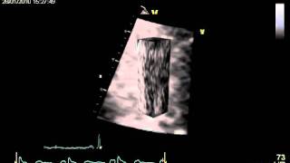 LONGITUDINAL MYOCARDIAL DEFORMATION MECHANICS [upl. by Basir]