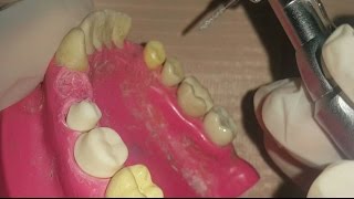 Introduction in fixed prosthodontics [upl. by Tudor]