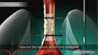 SampG BiotechEGIS Airway Stent [upl. by Rudich210]