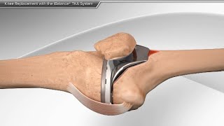 Knee Replacement with the iBalance TKA System [upl. by Anneirb]