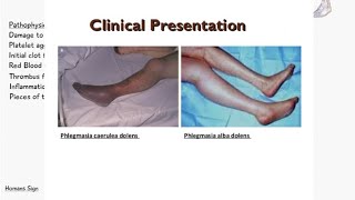 Phlegmasia Cerulea Dolens VS Phlegmasia Alba Dolens  Deep Vein Thrombosis  Signs and Symptoms [upl. by Adila]