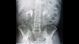 BANGLA TECHNIQUE OF IVUINTARVENOUS UROGRAMPROCEDURES OF IVU TEST [upl. by Olsen]