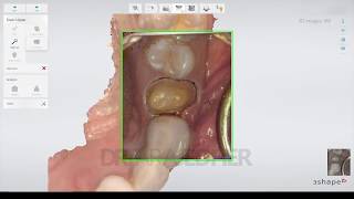 Intraoral scanning for a single crown prep Trios 3Shape [upl. by Hamachi]