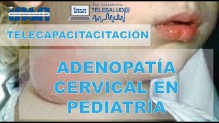 Adenopatía Cervical en Pediatría  Telecapacitación INSN [upl. by Gnuh]