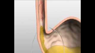 Endostim slokdarm kringspier stimulatie tegen zuurbranden [upl. by Asiil]