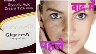 Pimples Acne और Whitening क्रीमGlyco A 12glyco A 12 creamglyco 6 [upl. by Westphal]