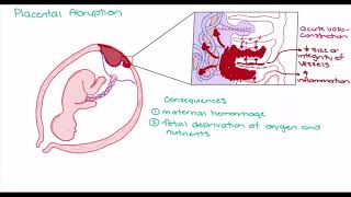 Placental Abruption [upl. by Eveivenej769]