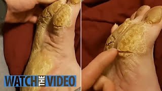 Removing Extremely Hard Foot Callus 🦶 The right way to remove foot callus FULL TREATMENT 06 [upl. by Bik]