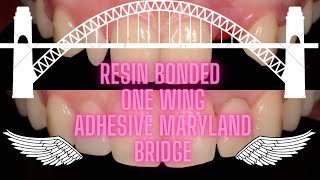 Cantilever Adhesive Bonded Maryland Bridge EMAX Lateral Incisor Agenesis [upl. by Lovmilla]