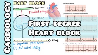 First Degree Heart Block made simple for USMLE NEET PG NCLEX [upl. by Avert]