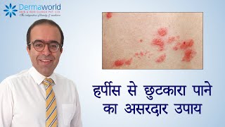 हर्पीस से छुटकारा पाने का असरदार उपाय  Dr Rohit Batra [upl. by Lirbij875]