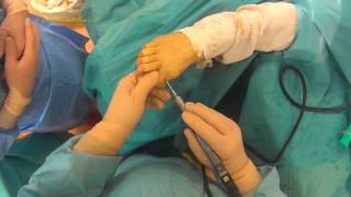 Hallux Valgus en chirurgie Mini Invasive Percutanée [upl. by Sugirdor]