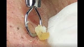 Blackheads Removal Big For Quyết  Hang Oliver  Part 315 [upl. by Gothart667]