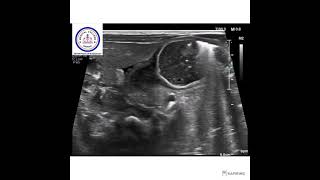 ULTRASOUND  CONGENITAL HYPERTROPHIC PYLORIC STENOSIS 2 [upl. by Ia]